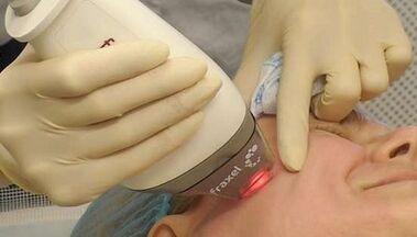 Kako poteka delno pomlajevanje kože