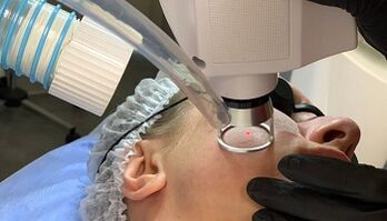 lasersko pomlajevanje kože obraza