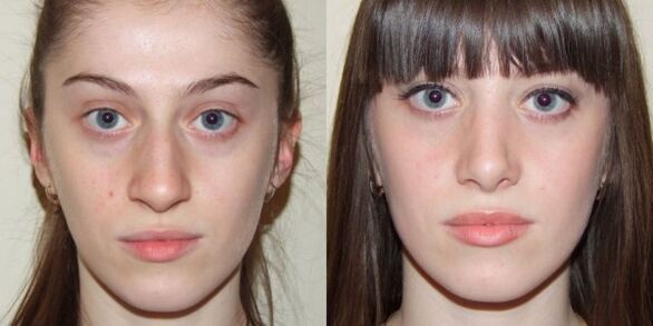 Dekle pred in po plazma pomlajevanju kože obraza