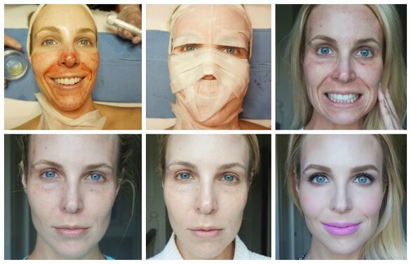 Faze celjenja kože obraza po uspešnem plazma liftingu