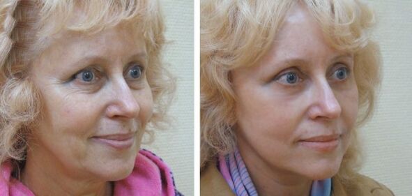 Ženska pred in po pomlajevanju kože obraza s plazmo